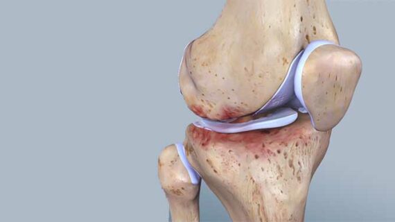 Why do more females than males get knee osteoarthritis?